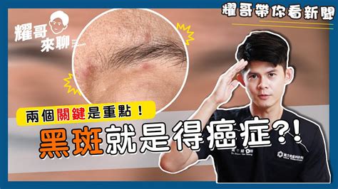 屁股長黑斑|黑斑 (Melasma)